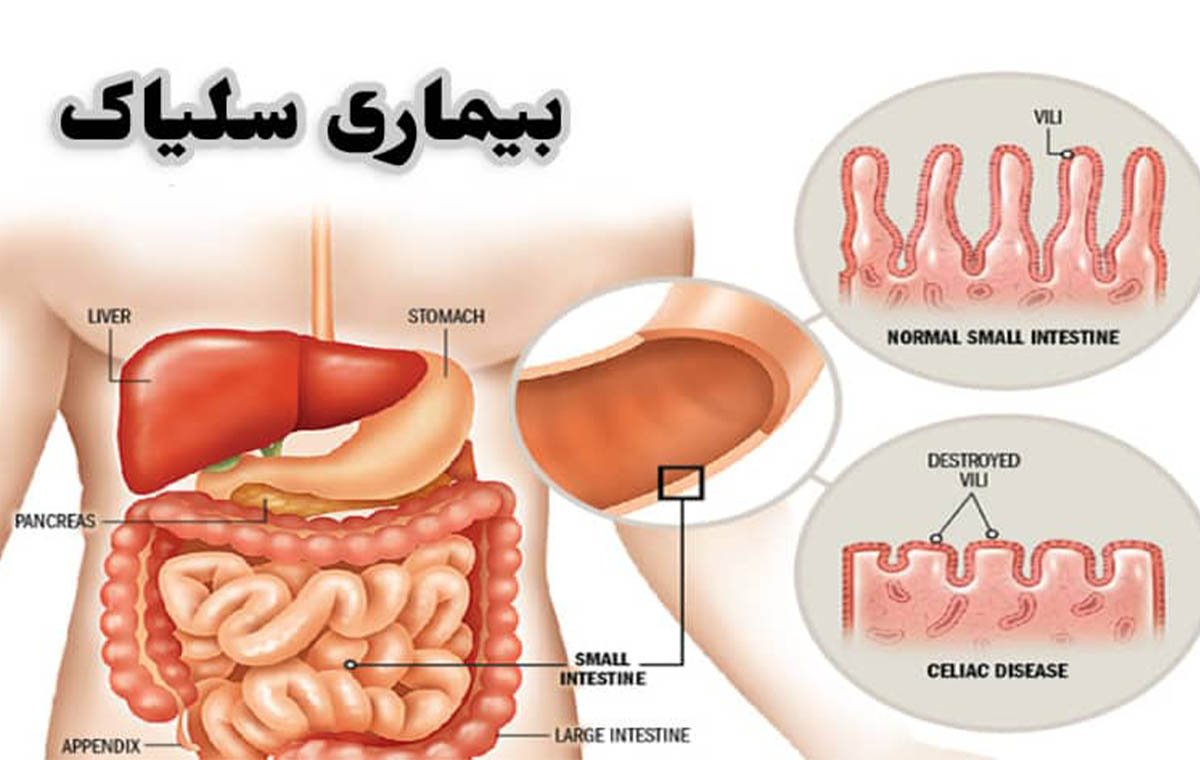 بیماری سلیاک چیست؟